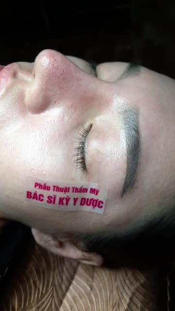 NÂNG MŨI SAU 45 PHÚT