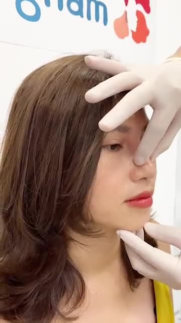 Nhan sắc KIỀU DIỄM sau 11 tháng Nâng mũi cấu trúc 4D Nanoform