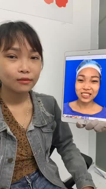"Giải cứu" HÀM DẬP - MÓM do tai nạn MÍ LỆCH