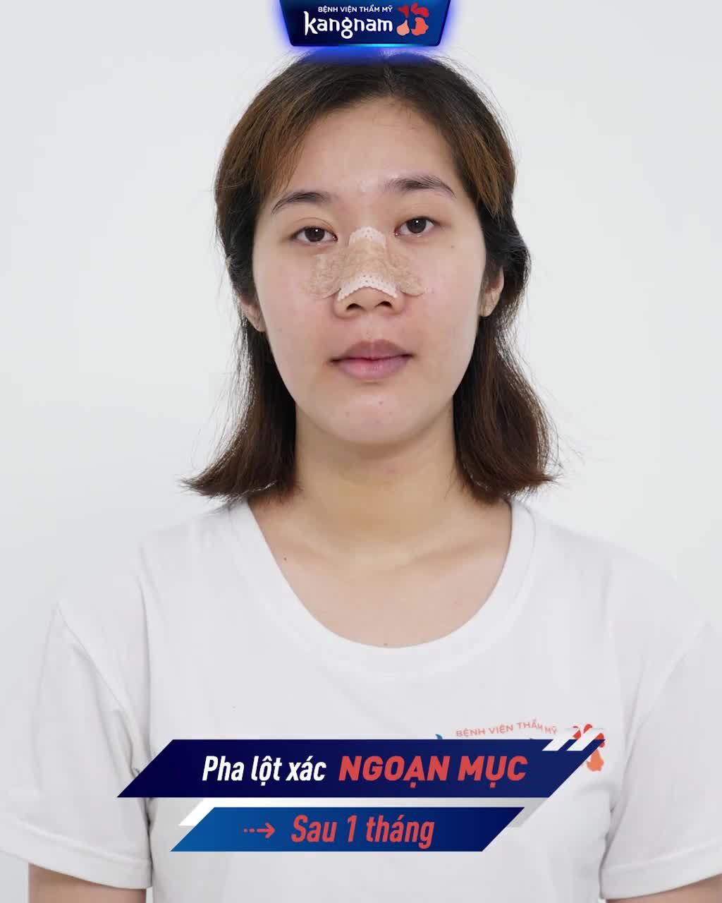 180 phút - 3 dịch vụ chỉnh hàm: Khắc phục HÔ toàn diện
