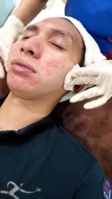 Da "hồi sinh", cải thiện không ngờ sau mỗi buổi trị mụn Nano Skin