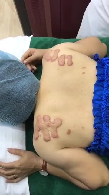 Điều trị sẹo lồi ở bả vai "cực lớn" tại Đông Á