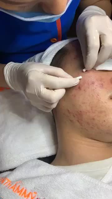 Quy trình điều trị mụn tại BVTM KANGMAM - sạch mụn 90% sau liệu trình điều trị duy nhất!
