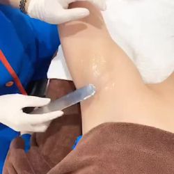 Quy trình triệt  lông nách vĩnh viễn tại bvtm Kangnam - lông nách cải thiện 100% sau liệu trình