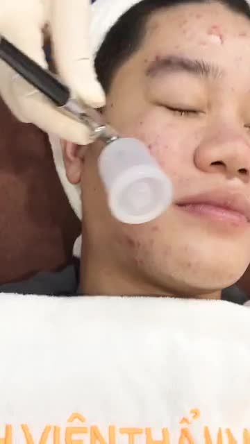 Quy trình điều trị mụn de acne - sạch mụn sau 1 liệu trình điều trị