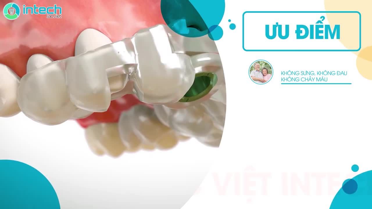 KỸ THUẬT TRỒNG RĂNG IMPLANT USI - CÔNG NGHỆ ĐỘC QUYỀN TẠI NHA KHOA LẠC VIỆT INTECH