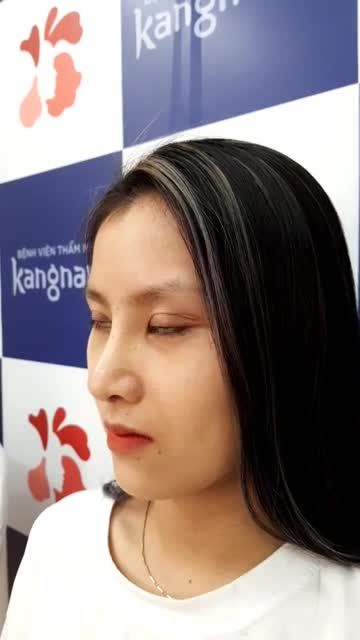 MŨI CAO TÂY - MẶT "SANG CHẢNH" - Kết quả chỉ sau 10 ngày Nâng mũi cấu trúc 4D