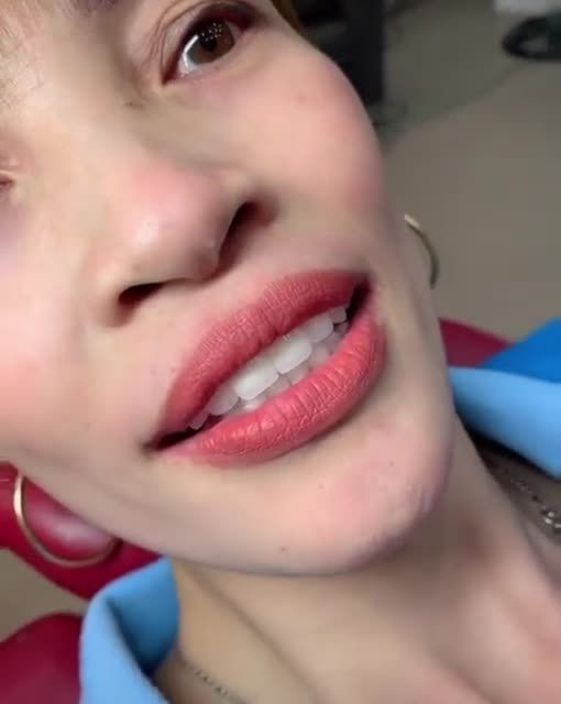 Khách hàng : chị Nhàn - với khuyết điểm trên răng cũ như