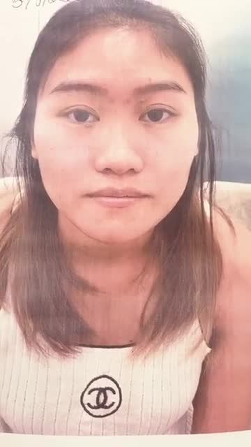 Khách hàng sóng mũi thấp, da mỏng, đầu mũi to bè. Khách hàng đã lựa chọn phương pháp cấu trúc sụn tai