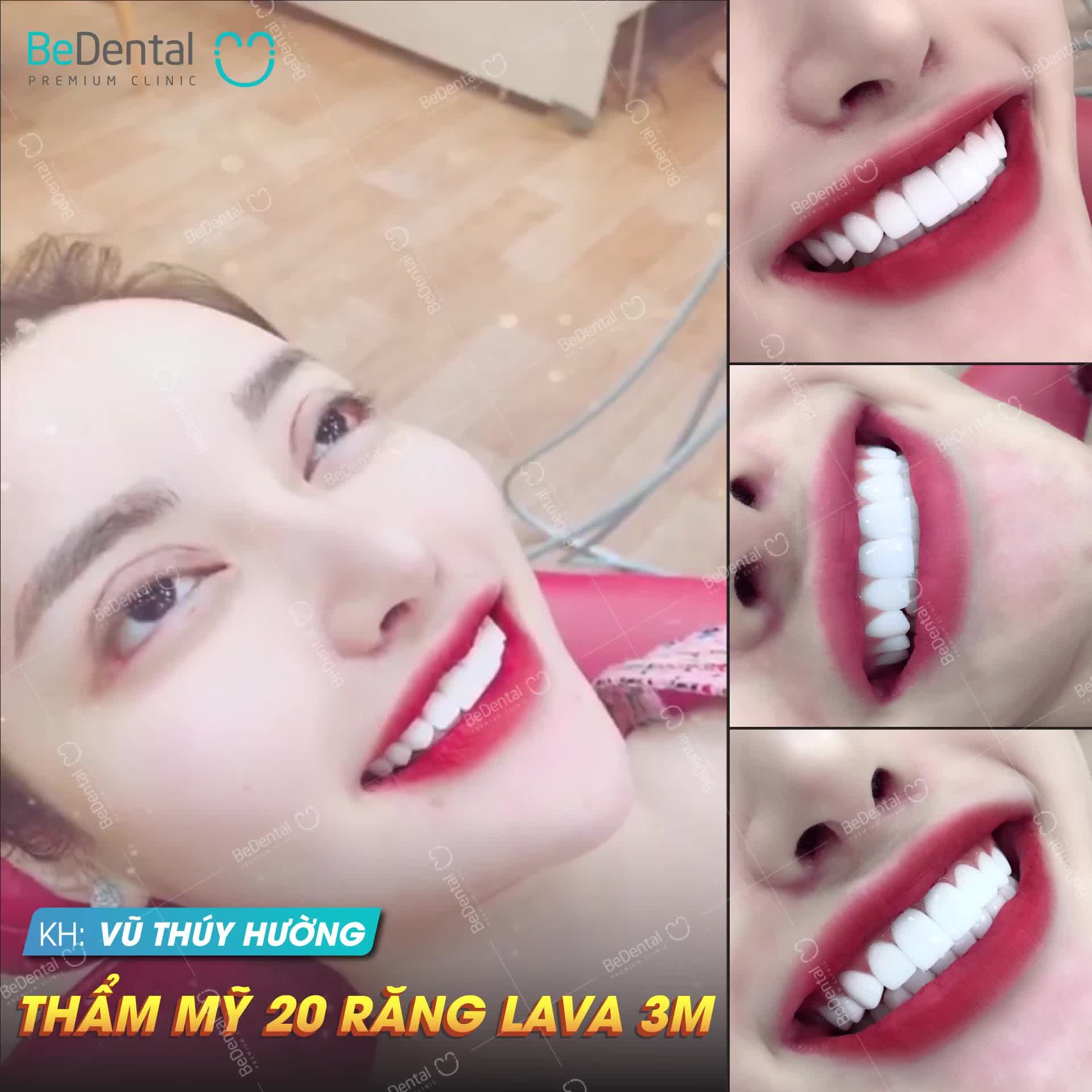 Khách nhà Be vừa thực hiện xong thẩm mỹ xong 20 răng sứ Lava 3M