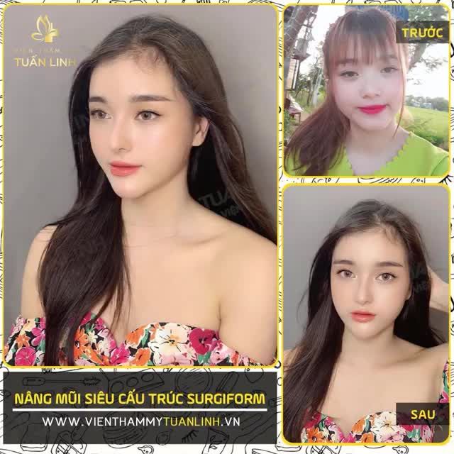 NÂNG MŨI SIÊU CẤU TRÚC SURGIFORM - KHẮC PHỤC KHUYẾT ĐIỂM HIỆU QUẢ - LÊN MỌI DÁNG MŨI TÙY THÍCH