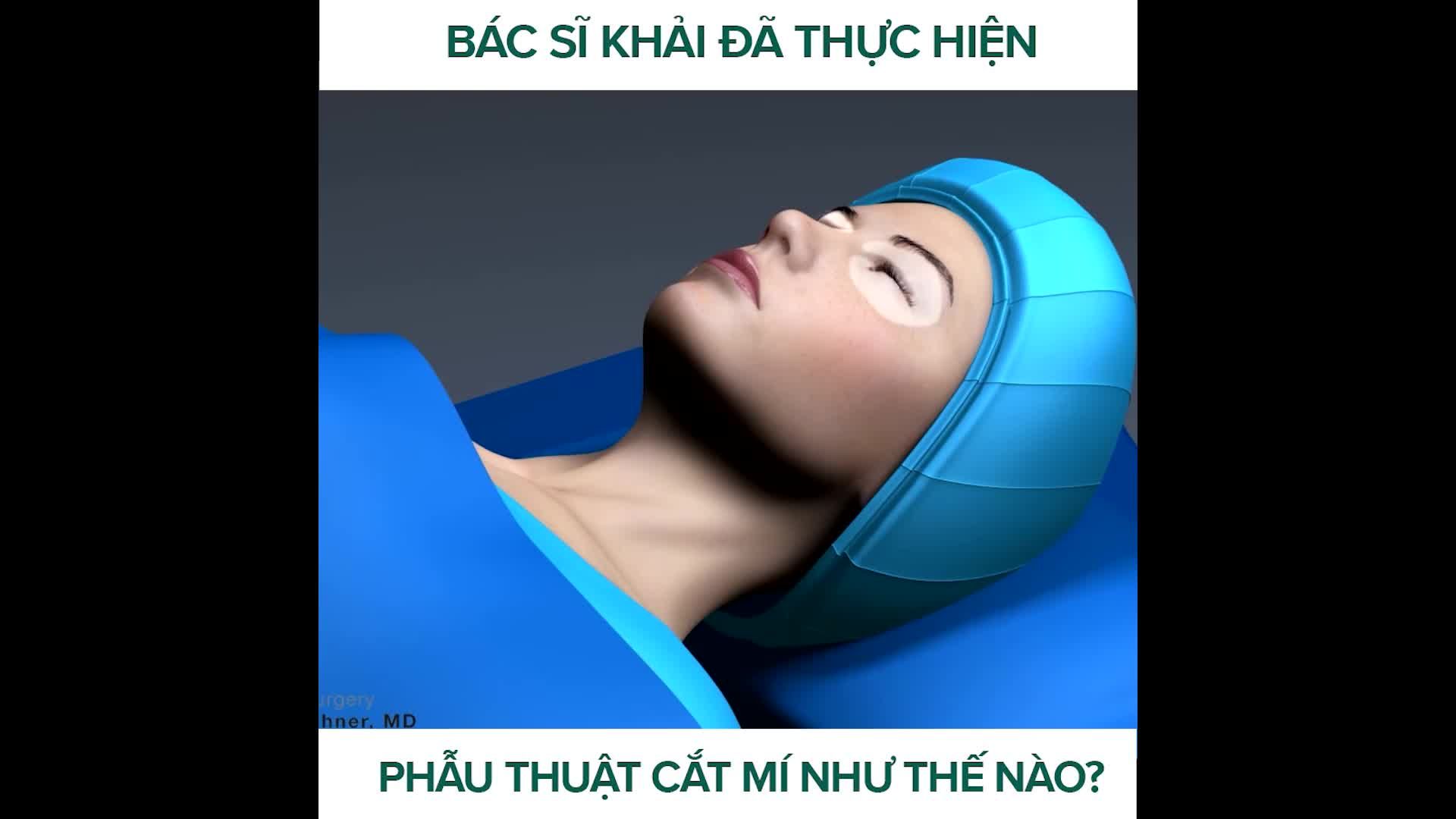 PHẪU THUẬT CẮT MÍ ĐƯỢC BÁC SĨ KHẢI THỰC HIỆN NHƠ THẾ NÀO