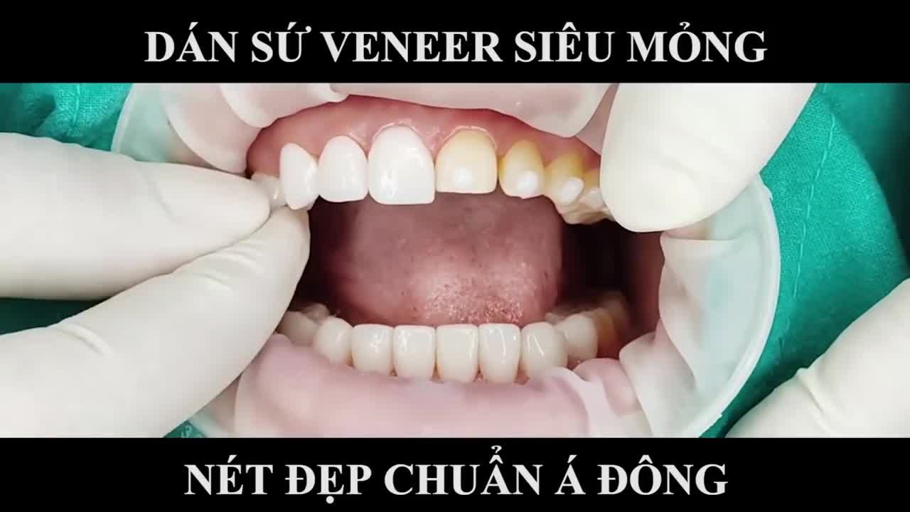 RẠNG RỠ NỤ CƯỜI DUYÊN VỚI MẶT DÁN VENEER SIÊU MỎNG