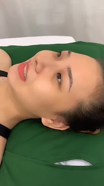 Khách hàng tái khám nâng mũi sau 3 tuần