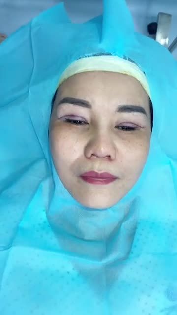 Một đôi mắt 4in1 sau 30 phút làm xong nhìn đôi mắt cực kì vui tươi hoàn toàn KHÔNG ĐAU, KHÔNG BẦM TÍM