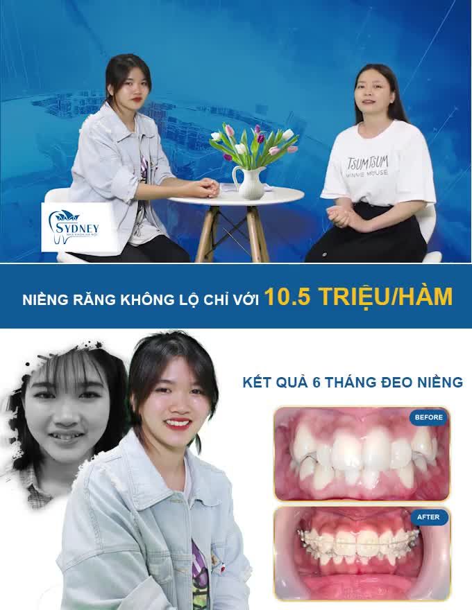NIỀNG RĂNG ĐỀU ĐẸP CHỈ SAU 6 THÁNG VỚI MẮC CÀI PHA LÊ