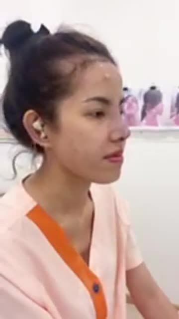 KH đã tiêm filler 1 năm, đầu mũi ngắn, sóng mũi to, đầu mũi to, xương bè 2 bên.