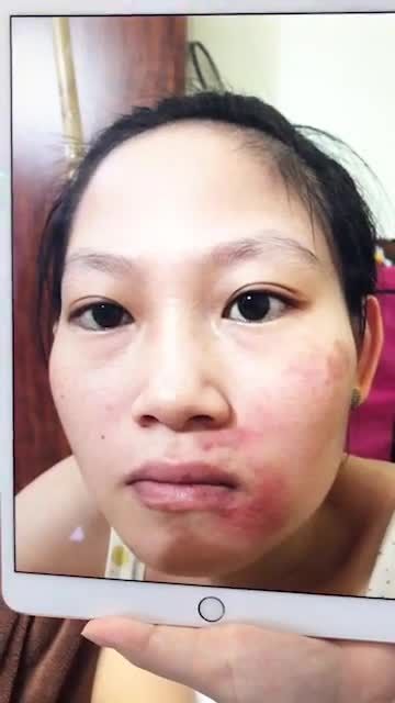 TUẦN VÀNG ĐIỀU TRỊ DA công nghệ cao  chỉ từ 99k