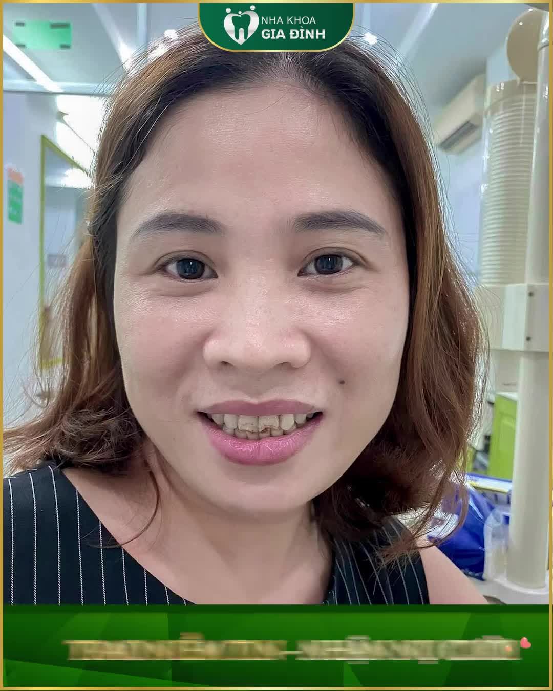 Chị Mỹ Hà sở hữu hàm răng nhiều bệnh lý khiến chị không chỉ ăn nhai khó khăn mà còn thiếu tự tin trong giao tiếp.