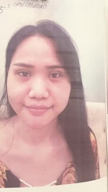Dáng mũi Sline cao cho khách hàng đầu mũi cụp