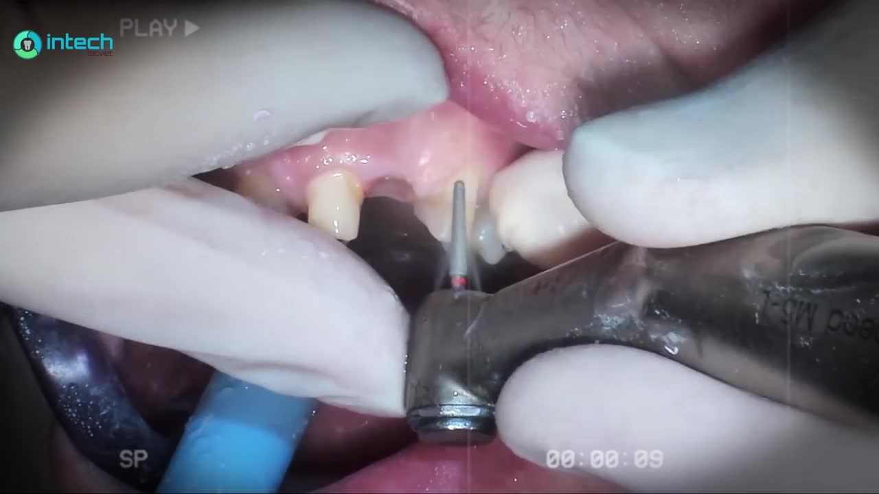 GIẢI CỨU NHỮNG CHIẾC RĂNG KHỎI NỖI SỢ HÃI LÀM CẦU RĂNG SỨ
