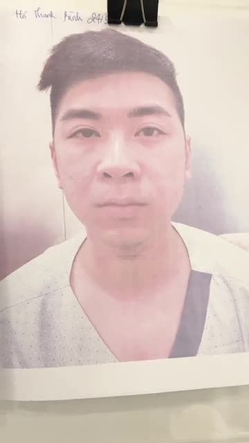Giải pháp cho khách hàng từng nâng mũi nhân tạo