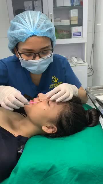 Khách hàng tái khám, cắt chỉ sau 10 ngày nâng mũi siêu cấu trúc sụn sườn nhân tạo tại Tuấn Linh