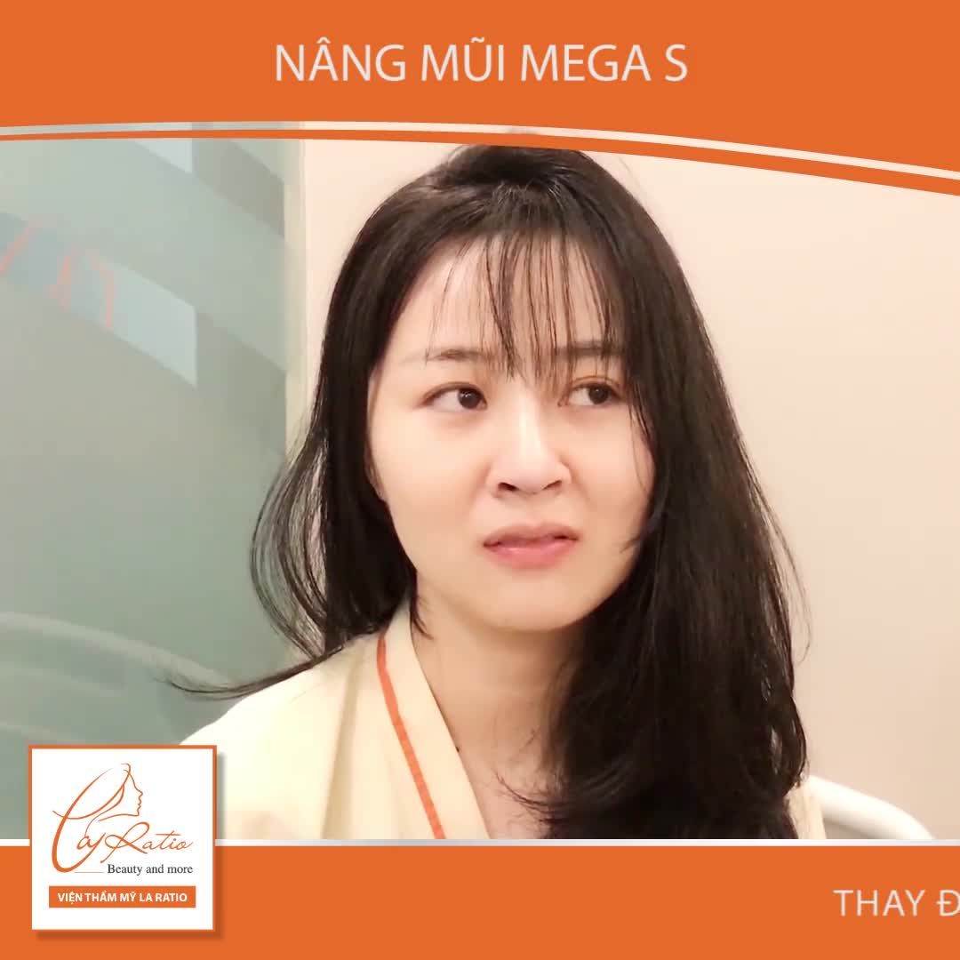 MŨI CAO THON GỌN - ĐẸP AN TOÀN – KHÔNG BĂNG NẸP CHỈ SAU 30 PHÚT THỰC HIỆN NÂNG MŨI MEGA S