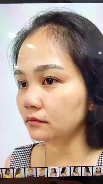 MŨI SLINE NANO FORM 4D tái khám sau 20 ngày lên dáng CỰC KÌ DUYÊN DÁNG với khách hàng.
