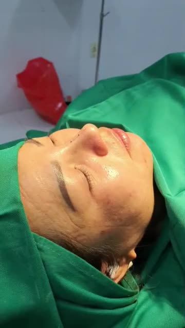 NÂNG MŨI BÁN CẤU TRÚC SỤN TAI ĐA LỚP sau 45 Phút
