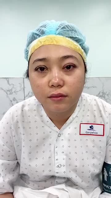 Ca mắt 4in1 chỉnh sụp cơ mi mắt bên phải đôi mắt hết đờ đẫn có điểm nhấn nhìn rất xuốn hút