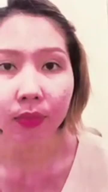 Ca nâng mũi cho khách hàng đến từ Bến Tre