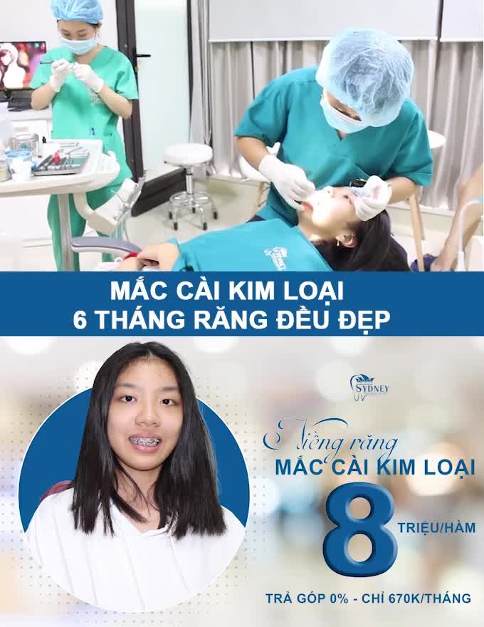 MẮC CÀI KIM LOẠI - BIỂU TƯỢNG CỦA NIỀNG RĂNG
