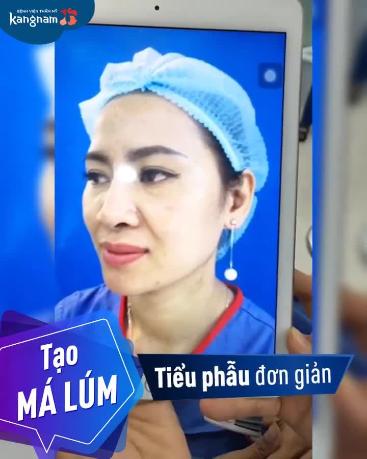 "Chớp mắt" có ngay MÁ LÚM duyên dáng