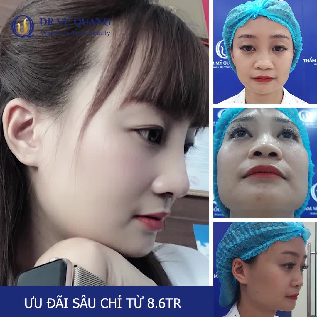 LỘT XÁC THÀNH HOT GIRL VẠN NGƯỜI MÊ VỚI MŨI CAO SANG CHẢNH: Thách thức mọi góc nghiêng với dịch vụ nâng mũi Softline.