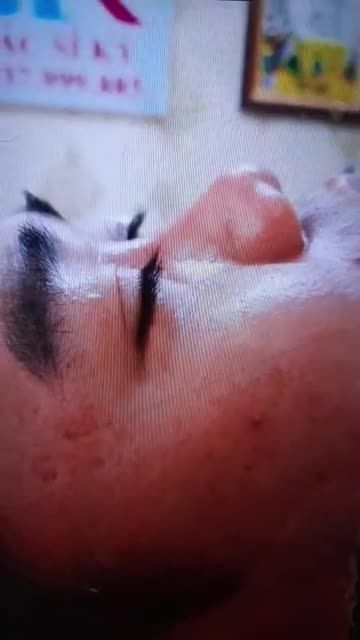 NÂNG MŨI BÁN CẤU TRÚC