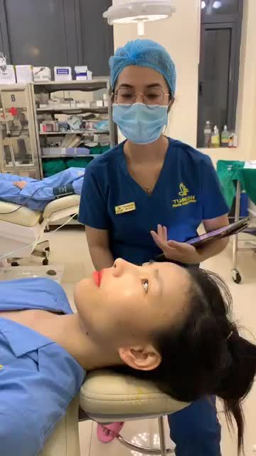 Nâng mũi siêu cấu trúc sụn sugiform Dáng sline tự nhiên