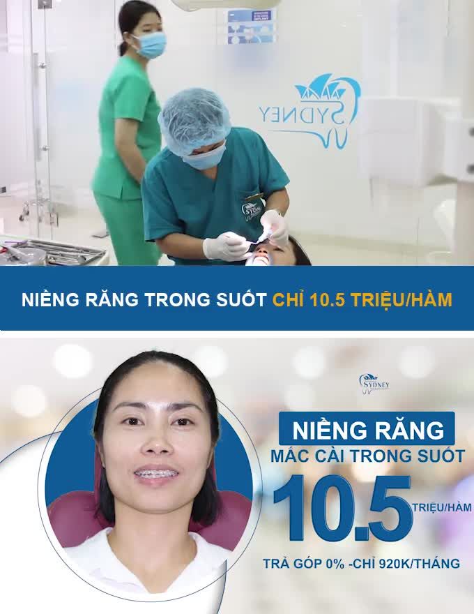 NIỀNG RĂNG MẮC CÀI NÀO MỚI TỐT