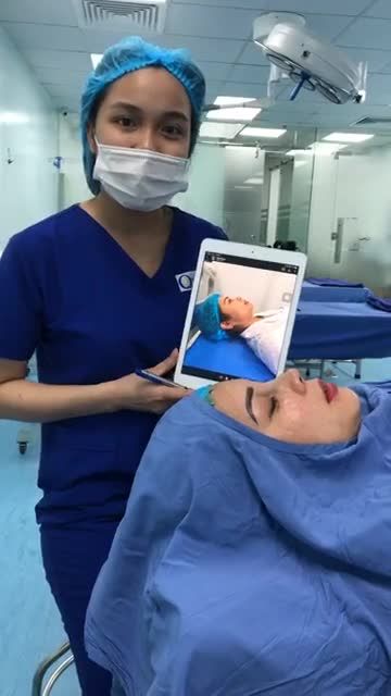 KẾT QUẢ " nâng mũi Softline "