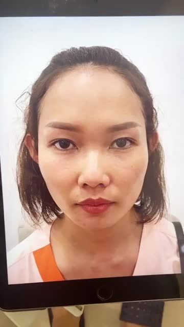 KH sóng mũi thấp, đầu mũi ngắn hếch, đầu mũi nghiêng qua phải, da mỏng.