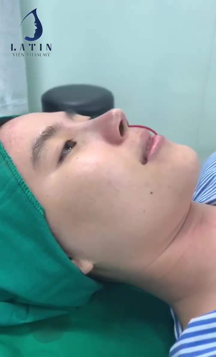 MŨI BÁN CẤU TRÚC SAU 1H15 PHÚT HOÀN HẢO