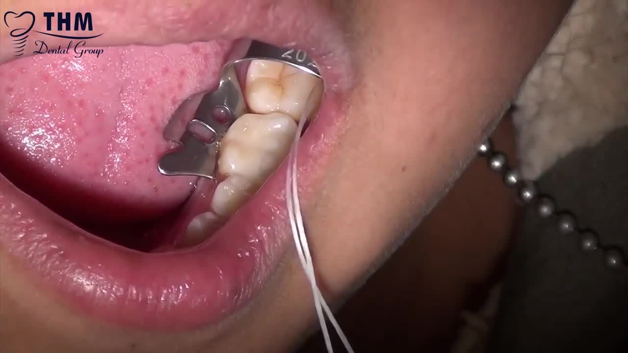 CHỮA TỦY CHO RĂNG ĂN NHAI