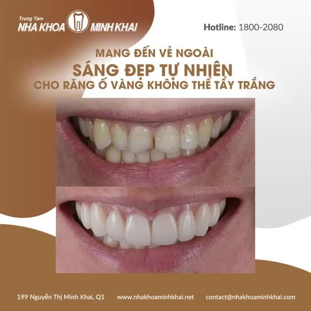 “Cứu vớt” hàng tiền đạo khiếm khuyết bẩm sinh với dán sứ Veneer “thần thánh”