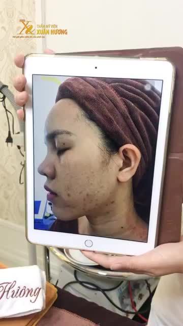 LỖ CHÂN LÔNG TO, DA SẦN VỎ CAM CŨNG PHẢI NHƯỜNG CHỖ CHO DA MỊN SÁNG HỒNG