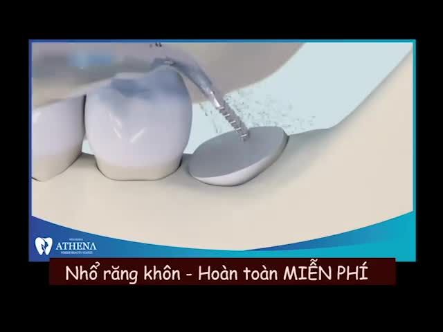 Năm ấy tiếc rẻ không nhổ răng khôn vì cũng chỉ hơi nhói