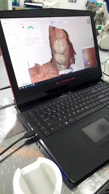 Quy trình scan lấy mẫu hàm 4.0 để thực hiện dịch vụ Niềng răng