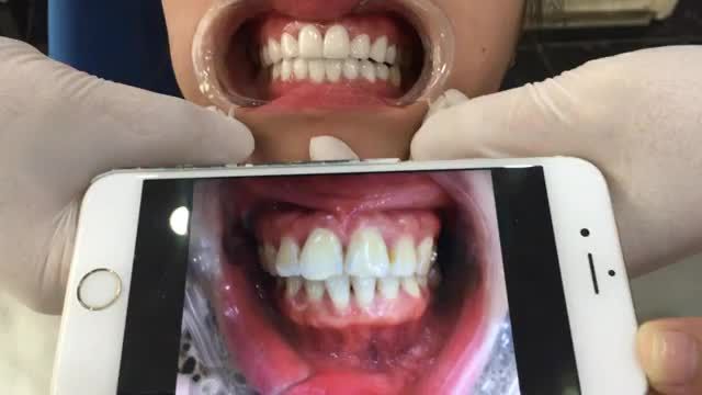 Răng đẹp nụ cười xinh, lắp thẩm mỹ toàn hàm Cho em gái Phú Thọ