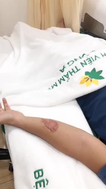 SẸO LỒI gây Ngứa? Mất thẩm mỹ? Khó chịu?
