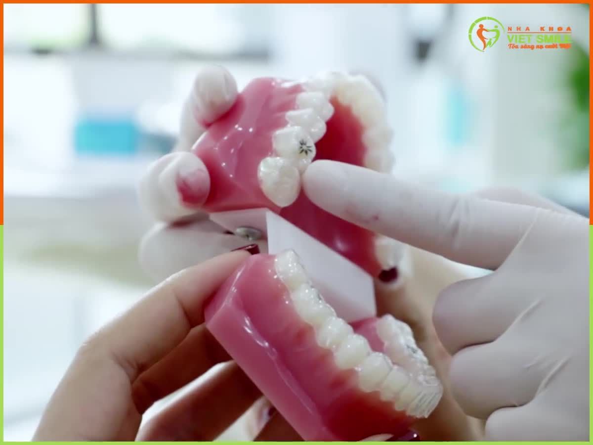 Trăm nghe không bằng 1 lần thấy, ngày 19, 20.09 này hãy tới nha khoa VIET SMILE Hà Nội và Hồ Chí Minh