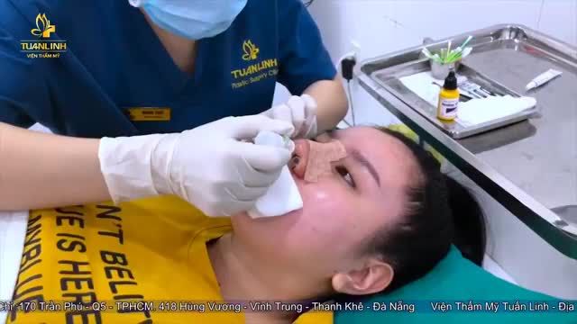 HƯỚNG DẪN CÁCH THÁO GẠC, VỆ SINH SAU NÂNG MŨI